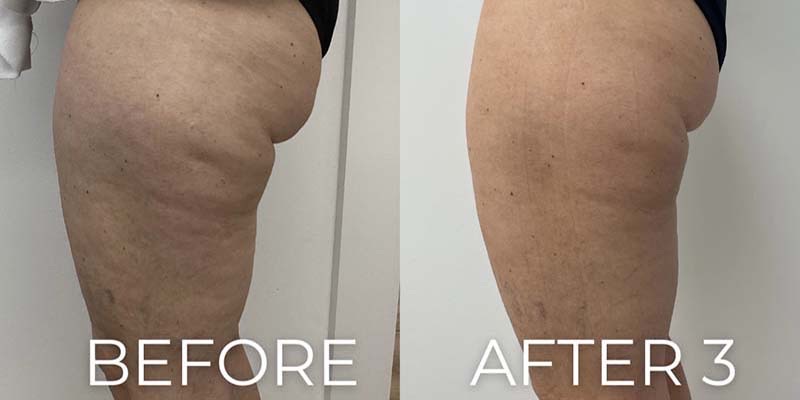 Body Sculpting Before & After Image