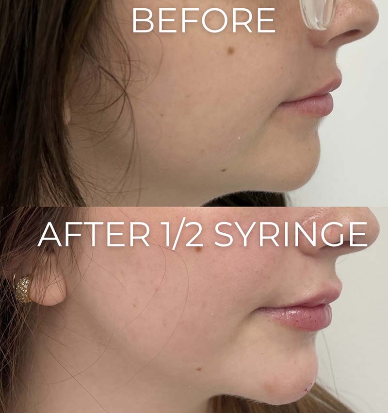 Chin & Jawline Fillers Before & After Image