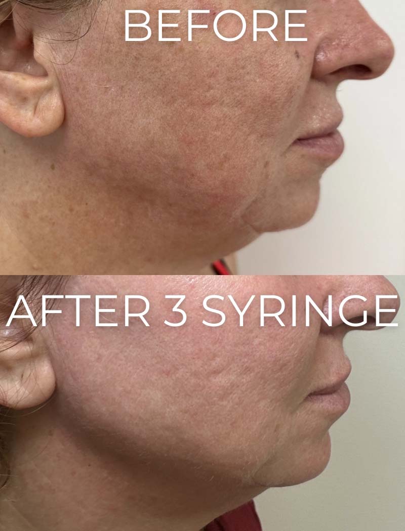 Chin & Jawline Fillers Before & After Image