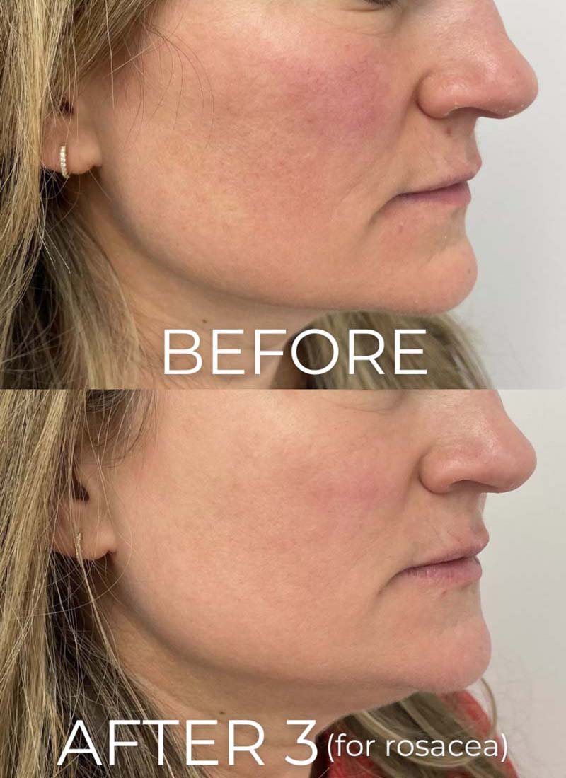 IPL Photofacial Before & After Image