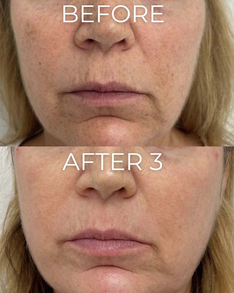 IPL Photofacial Before & After Image