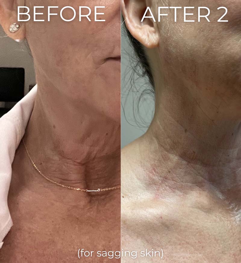 Opus Plasma Before & After Image