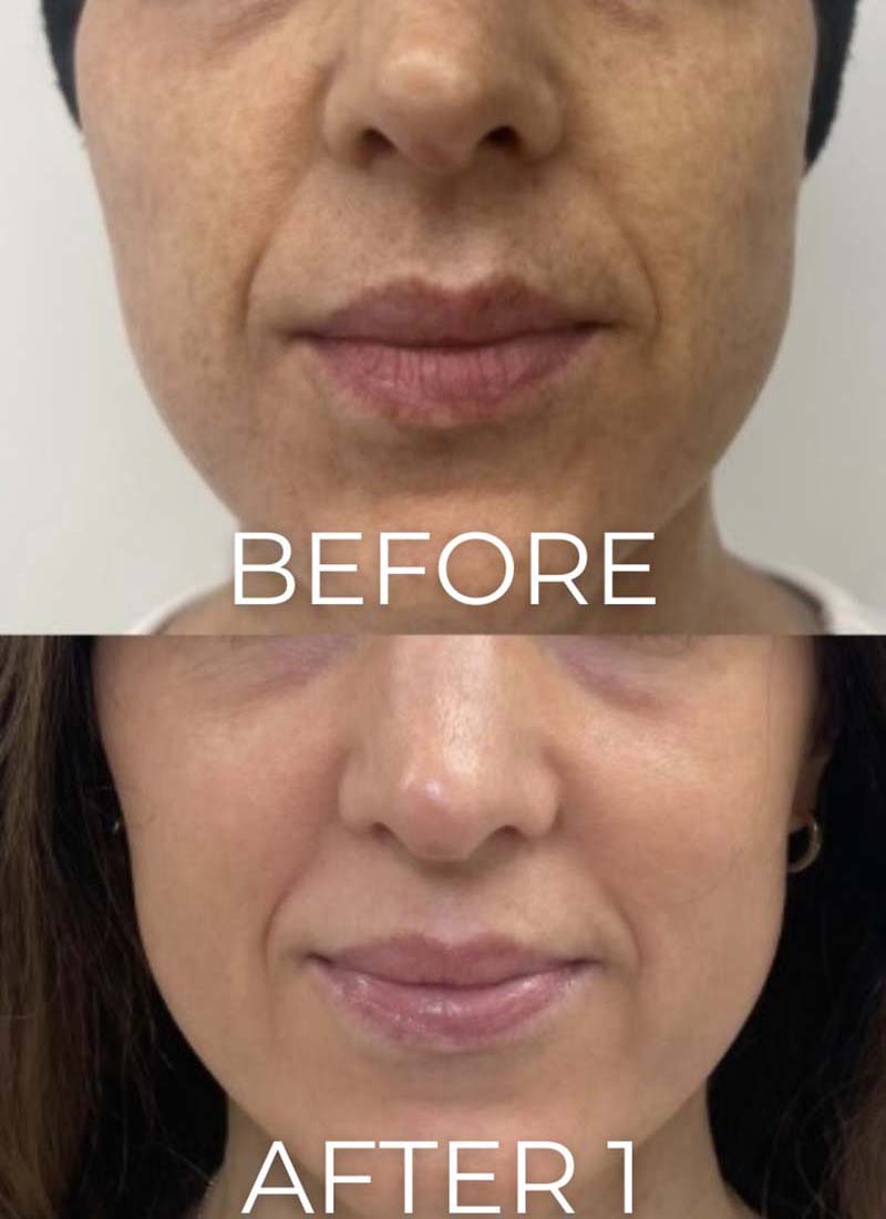 Chemical Peels Before & After Image