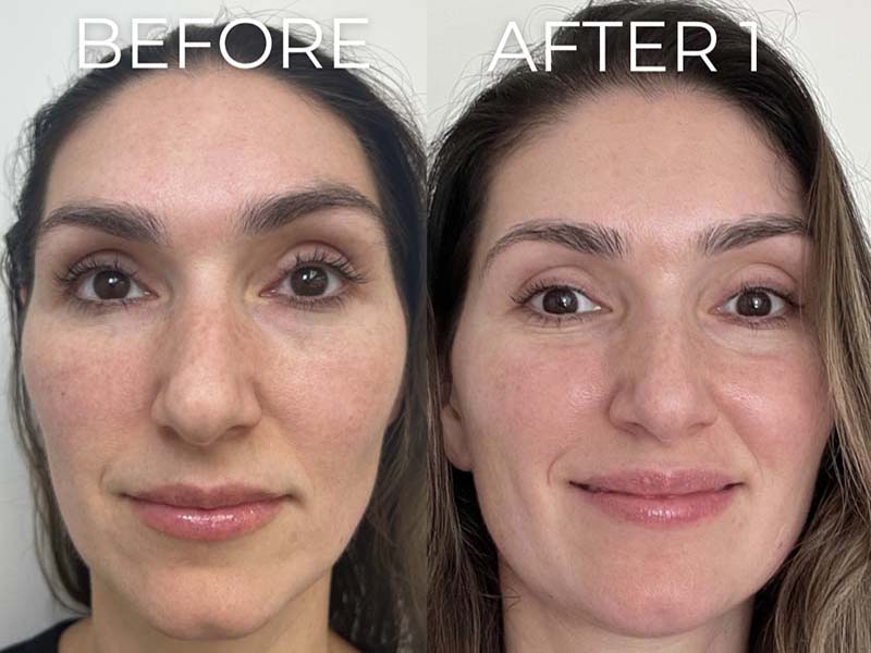 Chemical Peels Before & After Image