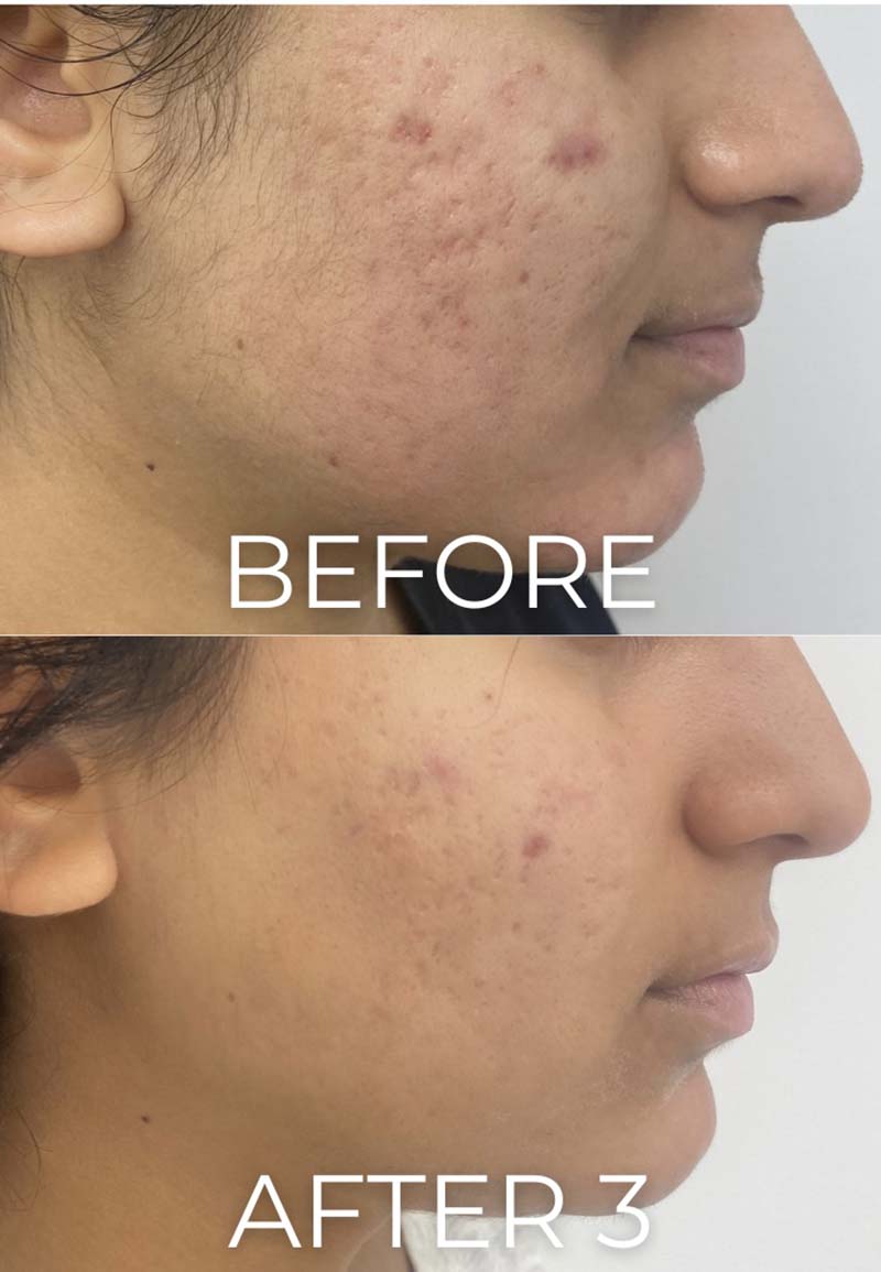 Microneedling Before & After Image