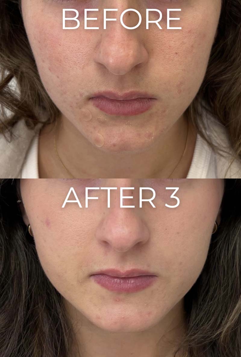 Microneedling Before & After Image