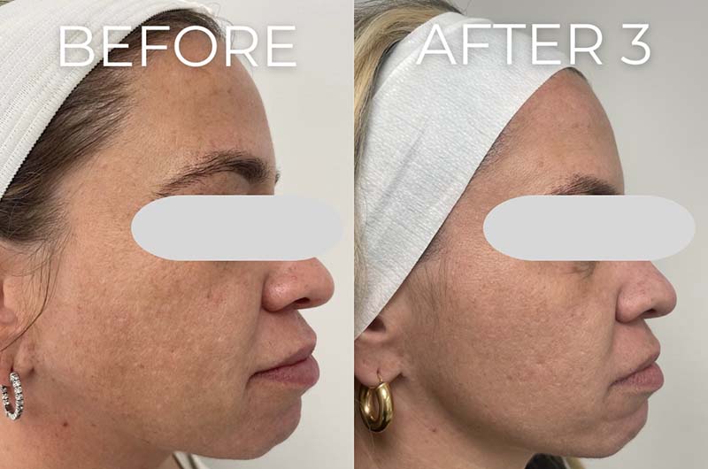 Microneedling Before & After Image